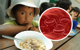 Anemia en Perú: una epidemia silenciosa que afecta a niños, mujeres y pacientes con cáncer